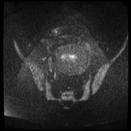 File:Adenomyosis-scar endometriosis (Radiopaedia 65863-75022 Axial DWI 3).jpg