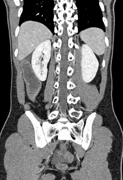 Adhesional small bowel obstruction (Radiopaedia 52107-57980 Coronal C+ portal venous phase 62).jpg