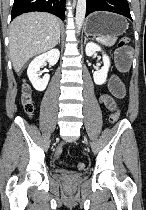 Adhesional small bowel obstruction (Radiopaedia 58900-66131 Coronal C+ portal venous phase 164).jpg