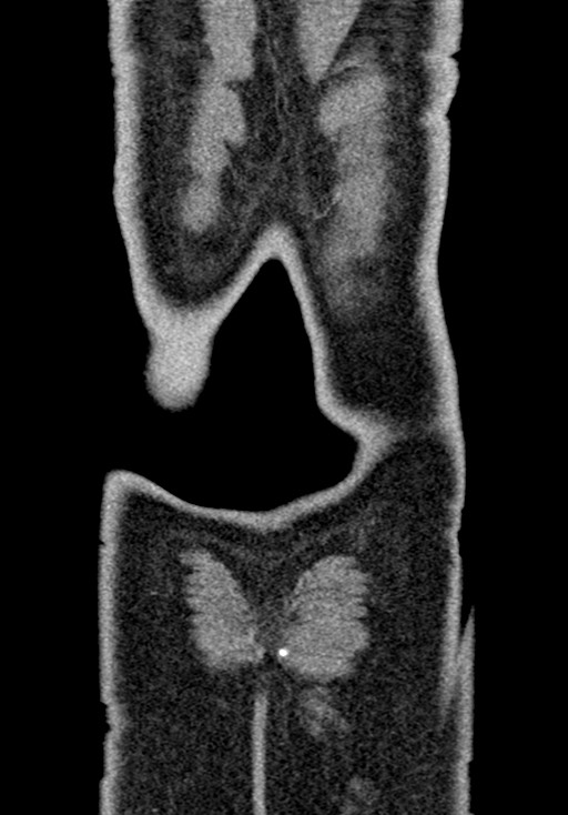 Adhesional small bowel obstruction (Radiopaedia 58900-66131 Coronal C+ portal venous phase 233).jpg