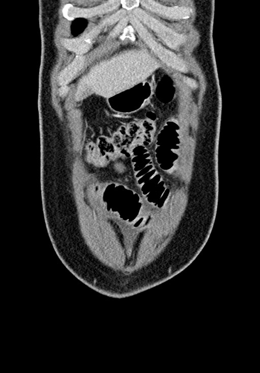 Adhesional small bowel obstruction (Radiopaedia 58900-66131 Coronal C+ portal venous phase 68).jpg