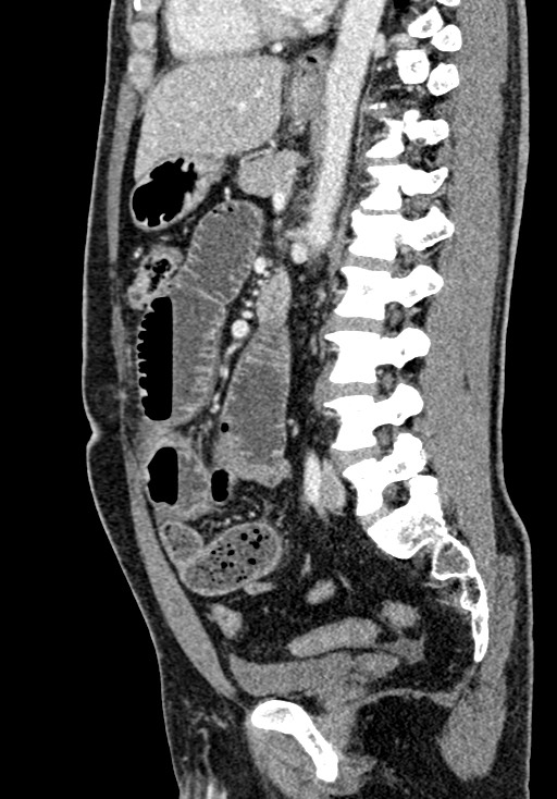 Adhesional small bowel obstruction (Radiopaedia 58900-66131 Sagittal C+ portal venous phase 142).jpg