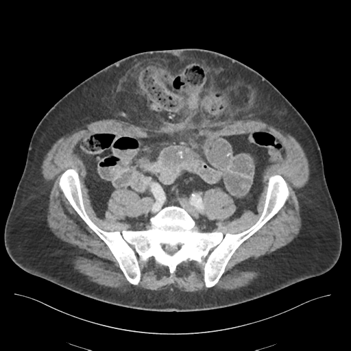 Adhesions within abdominal wall hernia (Radiopaedia 58283-65394 Axial C+ portal venous phase 60).png