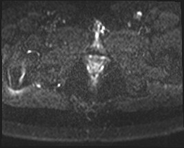 Adnexal multilocular cyst (O-RADS US 3- O-RADS MRI 3) (Radiopaedia 87426-103754 Axial DWI 25).jpg