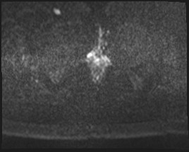 Adnexal multilocular cyst (O-RADS US 3- O-RADS MRI 3) (Radiopaedia 87426-103754 Axial DWI 59).jpg