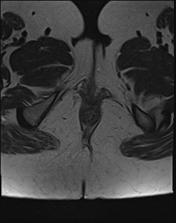 File:Adnexal multilocular cyst (O-RADS US 3- O-RADS MRI 3) (Radiopaedia 87426-103754 Axial T2 30).jpg