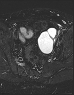 File:Adnexal multilocular cyst (O-RADS US 3- O-RADS MRI 3) (Radiopaedia 87426-103754 Axial T2 fat sat 12).jpg