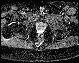 File:Adnexal multilocular cyst (O-RADS US 3. O-RADS MRI 3) (Radiopaedia 87426-103754 Axial 166).jpeg