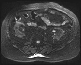 Adrenal cortical carcinoma (Radiopaedia 64017-72770 Axial DWI 73).jpg