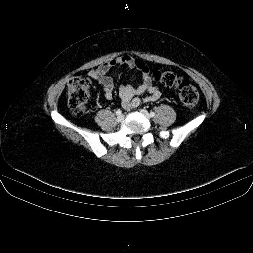 Adrenal cortical carcinoma (Radiopaedia 84882-100379 Axial C+ portal venous phase 65).jpg