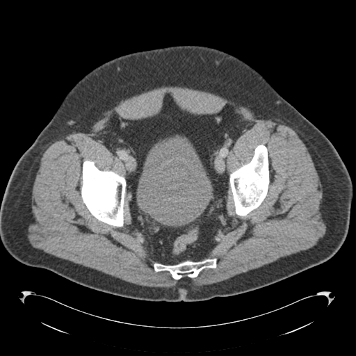 File:Adrenal cyst (Radiopaedia 45625-49776 Axial C+ portal venous phase 87).png