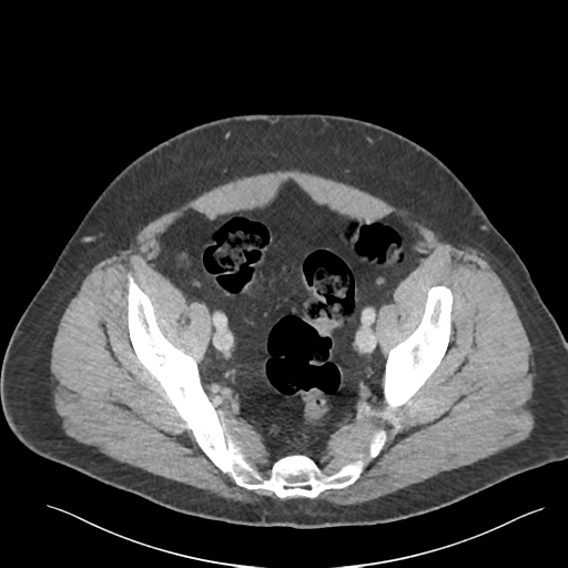 Adrenal cyst (Radiopaedia 45625-49777 Axial C+ portal venous phase 85).png