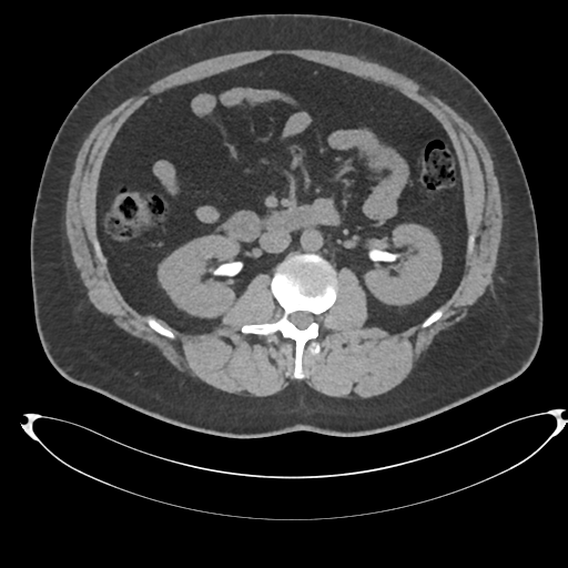 Adrenal cyst (Radiopaedia 45625-49778 Axial non-contrast 53).png