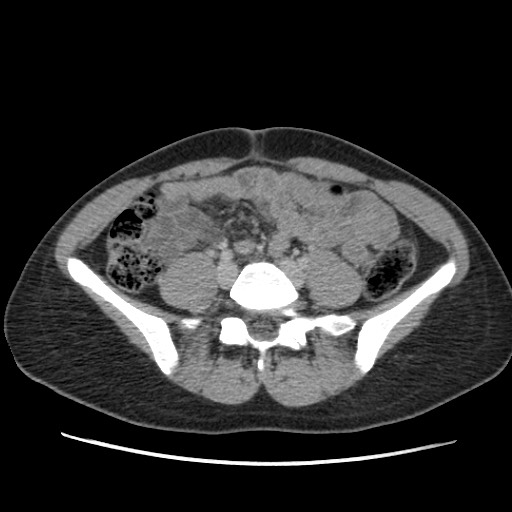 Adrenal cyst (Radiopaedia 64869-73813 Axial C+ portal venous phase 51).jpg