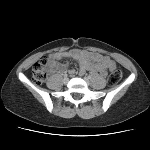 Adrenal cyst (Radiopaedia 64869-73813 Axial C+ portal venous phase 52).jpg