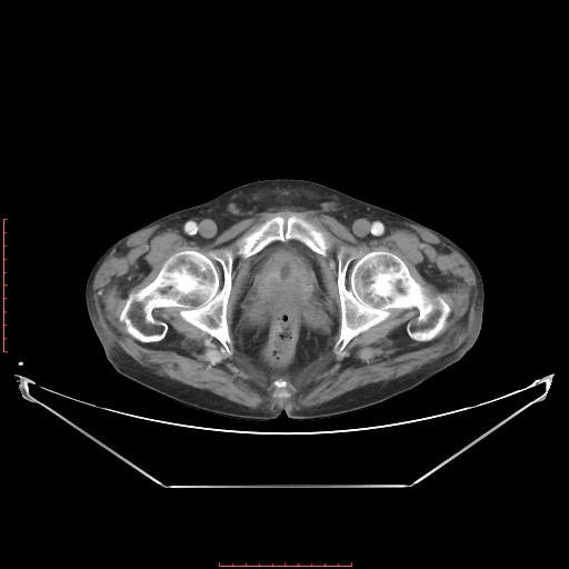 Adrenal hemangioma (Radiopaedia 68923-78668 Axial C+ portal venous phase 69).jpg