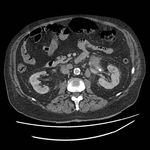 Adrenal lymphoma (Radiopaedia 84145-99415 Axial C+ portal venous phase 59).jpg