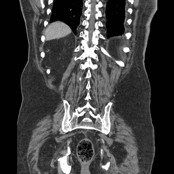 Adrenal lymphoma (Radiopaedia 84145-99415 Coronal C+ portal venous phase 73).jpg