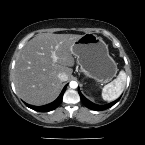 Adrenal myelolipoma (Radiopaedia 43401-46759 Axial C+ arterial phase 20).jpg