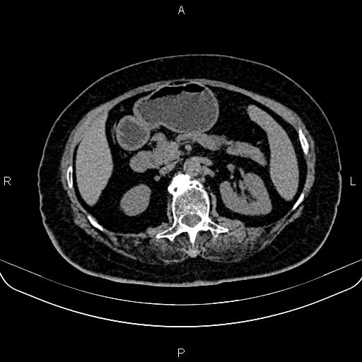 Adrenal myelolipoma (Radiopaedia 82742-96986 Axial non-contrast 58).jpg