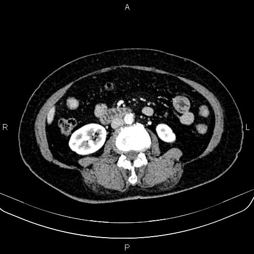 File:Adrenal myelolipoma (Radiopaedia 82742-96986 Axial renal cortical phase 91).jpg