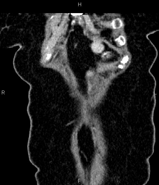 Adrenal myelolipoma (Radiopaedia 82742-96986 Coronal renal cortical phase 11).jpg