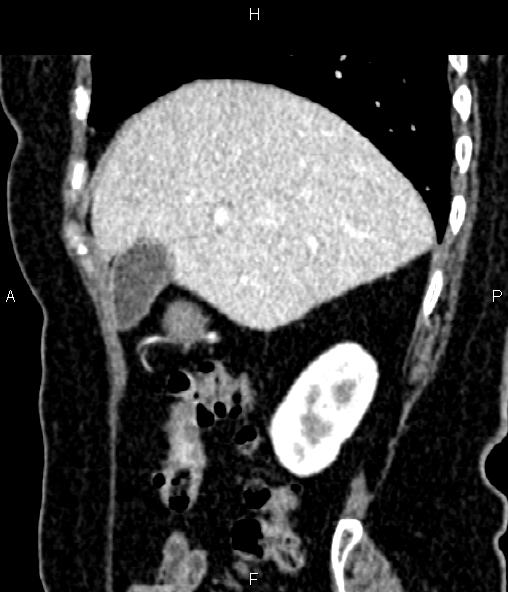 Adrenal myelolipoma (Radiopaedia 82742-96986 Sagittal renal cortical phase 32).jpg