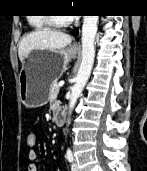 File:Adrenal myelolipoma (Radiopaedia 82742-96986 Sagittal renal cortical phase 61).jpg