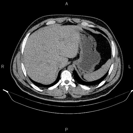File:Adrenal myelolipoma (Radiopaedia 84321-99619 Axial non-contrast 21).jpg
