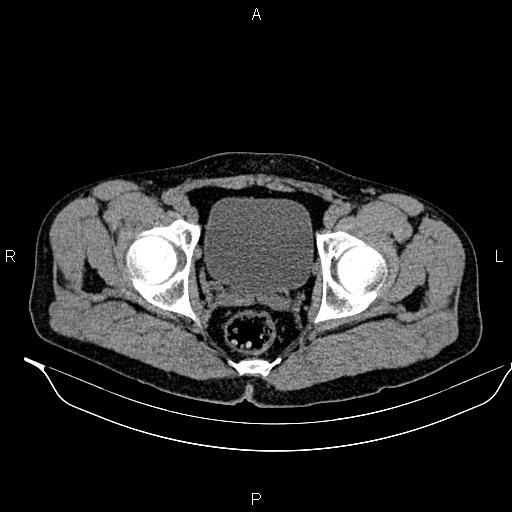 Adrenal myelolipoma (Radiopaedia 87794-104246 Axial non-contrast 100).jpg