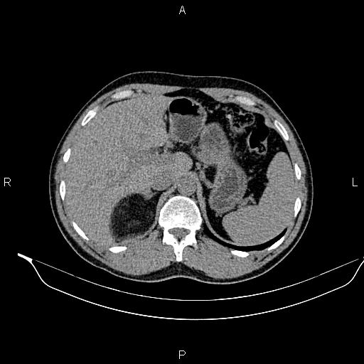 Adrenal myelolipoma (Radiopaedia 87794-104246 Axial non-contrast 27).jpg