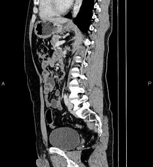 Adrenal myelolipoma (Radiopaedia 87794-104246 Sagittal renal cortical phase 56).jpg