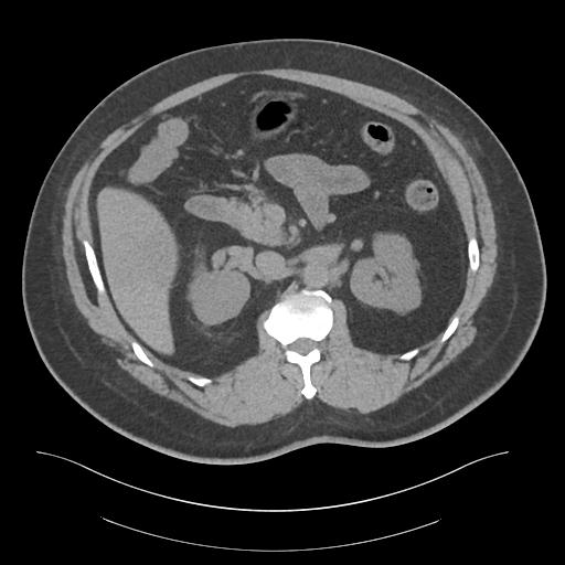 File:Adrenal vein sampling and adrenal nodular hyperplasia - Conn syndrome (Radiopaedia 30561-31337 Axial non-contrast 32).jpg