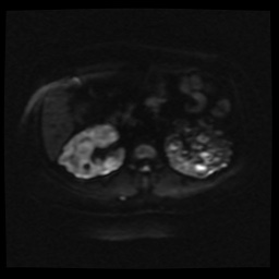 Adult polycystic kidney disease (Radiopaedia 59075-66365 Axial DWI 20).jpg
