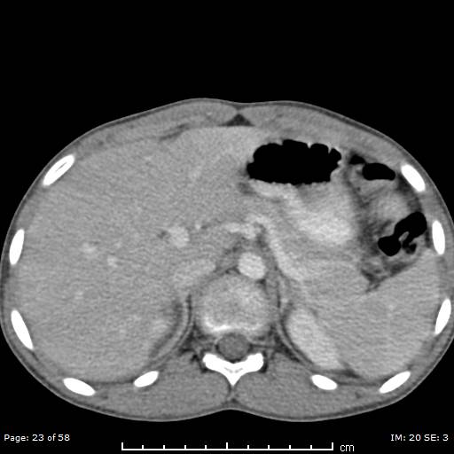 Agenesis of the gallbladder (Radiopaedia 55454-61905 B 23).jpg