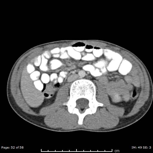 Agenesis of the gallbladder (Radiopaedia 55454-61905 B 52).jpg