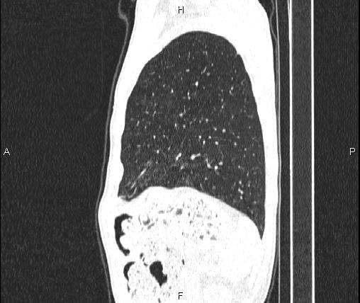 Air bronchogram in pneumonia (Radiopaedia 85719-101512 Sagittal lung window 83).jpg