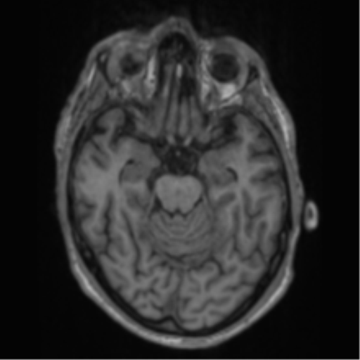 Alzheimer's disease- with apraxia (Radiopaedia 54763-61011 Axial T1 28).png