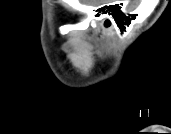 File:Ameloblastoma (Radiopaedia 26645-26793 Sagittal C+ delayed 1).jpg