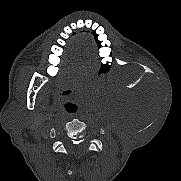 Ameloblastoma (Radiopaedia 51921-57766 Axial bone window 82).jpg