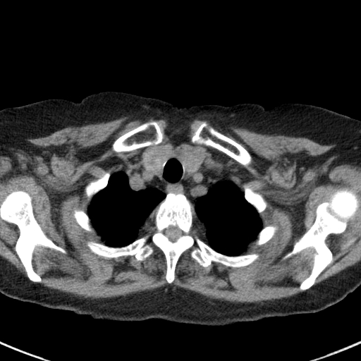 File:Amiodarone-induced pulmonary fibrosis (Radiopaedia 82355-96460 Axial non-contrast 10).jpg