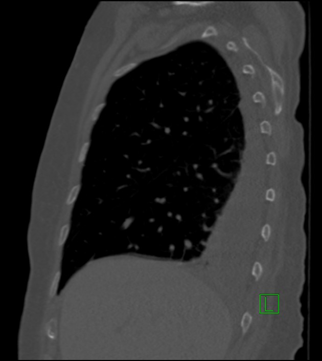 Amiodarone deposition in the liver (Radiopaedia 77587-89780 Sagittal bone window 73).jpg