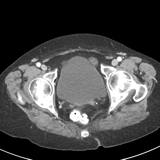 Ampullary adenocarcinoma (Radiopaedia 34013-35237 C 54).png
