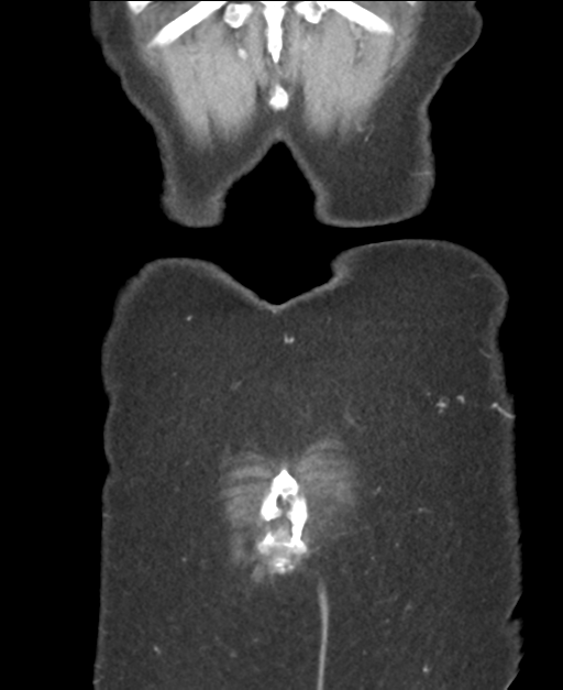 Ampullary adenocarcinoma (Radiopaedia 34013-35237 E 49).png