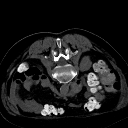 Ampullary adenocarcinoma (Radiopaedia 34013-35241 C 56).png