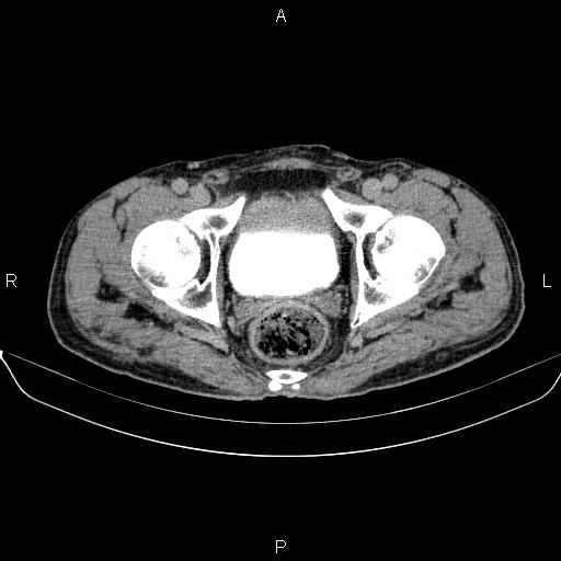 Ampullary adenocarcinoma (Radiopaedia 86093-102032 Axial C+ delayed 99).jpg