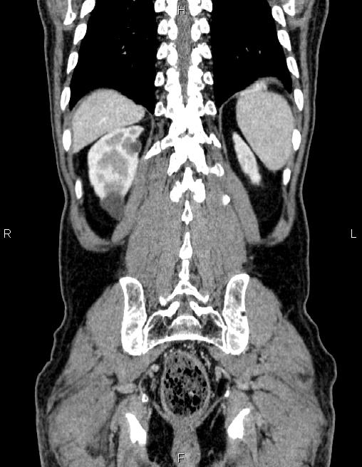 Ampullary adenocarcinoma (Radiopaedia 86093-102032 C 56).jpg