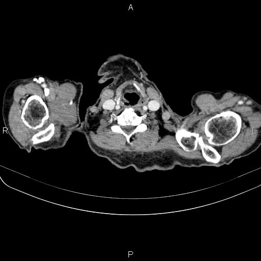 File:Ampullary adenocarcinoma (Radiopaedia 86093-102033 B 5).jpg