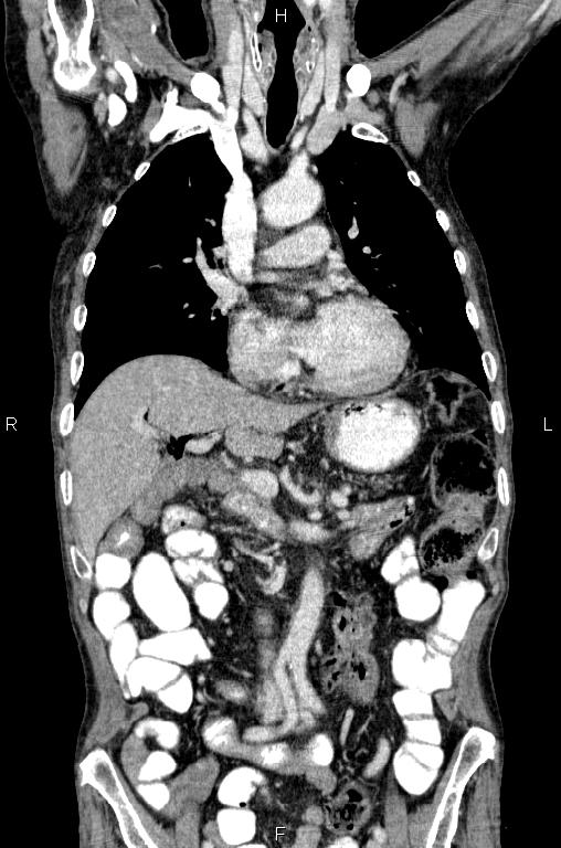 Ampullary adenocarcinoma (Radiopaedia 86093-102033 D 25).jpg