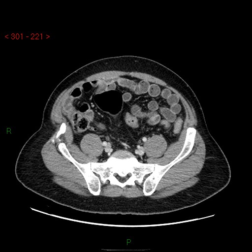 Ampullary carcinoma (Radiopaedia 56396-63056 C 75).jpg